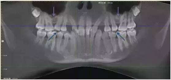 替牙期牙齿需要矫正吗,替牙期牙齿