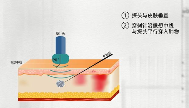 乳腺活检穿刺术操作方法,乳腺活检是怎么弄的