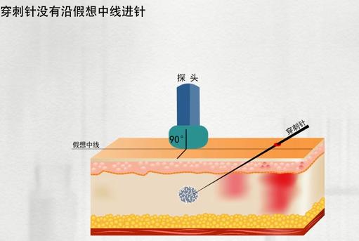 乳腺活检穿刺术操作方法,乳腺活检是怎么弄的