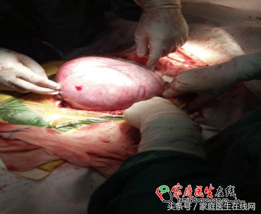 怀孕7个月发现胎儿身体里有肿瘤,怀孕22周胎儿有肿瘤