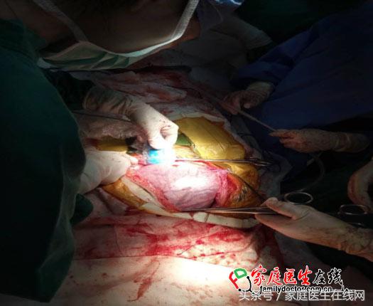 怀孕7个月发现胎儿身体里有肿瘤,怀孕22周胎儿有肿瘤