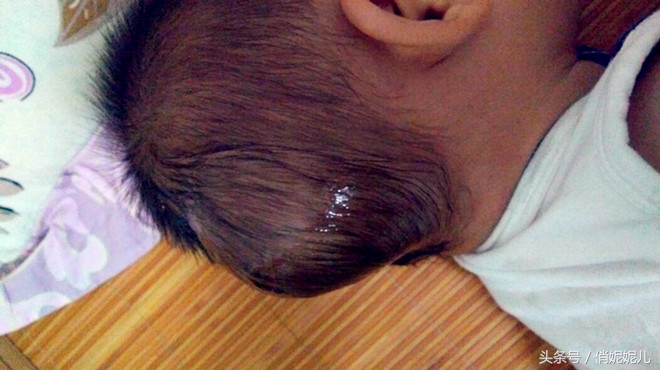 宝宝脑袋磕破了怎么办,宝宝脑袋磕了一个小包怎么办