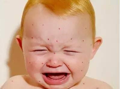 婴儿夏季常见皮肤病有哪些,一岁宝宝夏季常见皮肤病