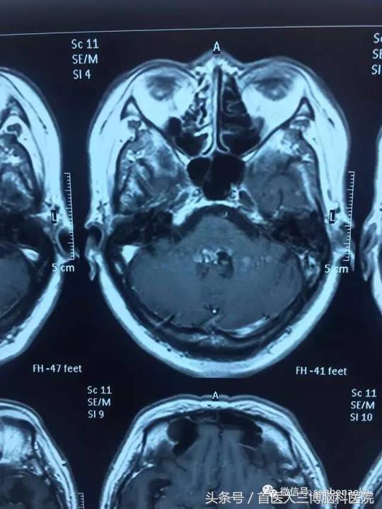 半年内多次脑出血心生绝望，学病友“跟风求医”