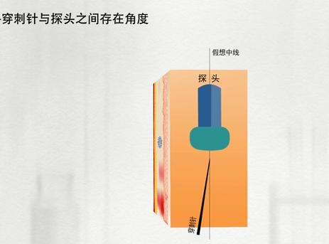 乳腺活检穿刺术操作方法,乳腺活检是怎么弄的