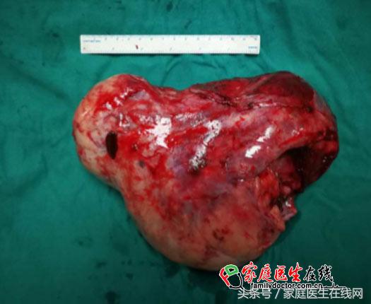 怀孕7个月发现胎儿身体里有肿瘤,怀孕22周胎儿有肿瘤