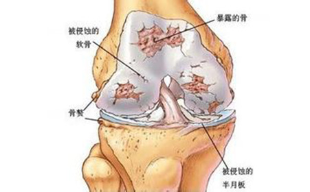 风湿病怎么治疗效果好,风湿病怎么治疗比较有效