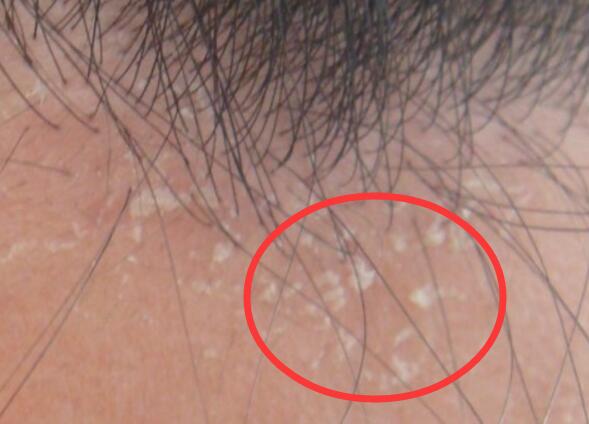 头皮屑有黄色痂块头皮发红,头皮上有一层白色的头皮屑还脱发