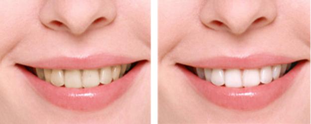 牙齿黄怎么办快速解决方法,牙齿黄是什么原因怎么解决