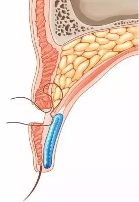 拿什么拯救术后三眼皮