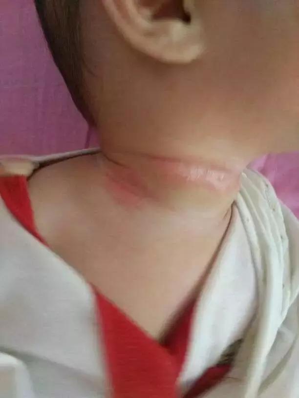 大人淹脖子护理方法超详细,大人夏天出汗脖子淹了怎么办