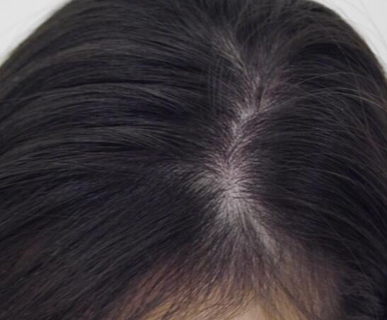 头皮屑有黄色痂块头皮发红,头皮上有一层白色的头皮屑还脱发