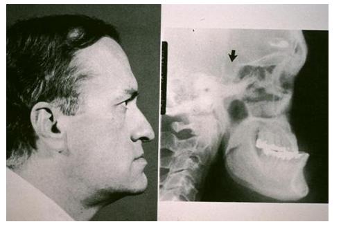 脑垂体瘤变丑,垂体瘤引起肢体肥大症能恢复吗