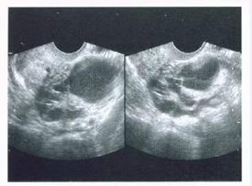 盆腔镜显影,超声盆腔显影术