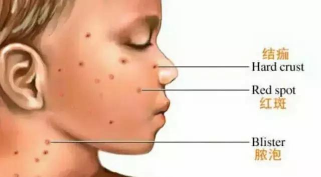 为什么说水痘不要吹风,小孩长水痘为什么不能吹风
