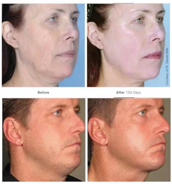 超声刀美容真有效果吗,超声刀美容导致的皮肤危害有哪些