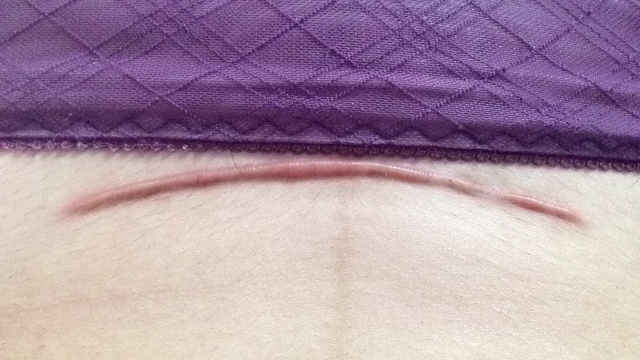 妈妈剖腹产怎么缝合,妈妈剖腹产宝宝出来怎样护理