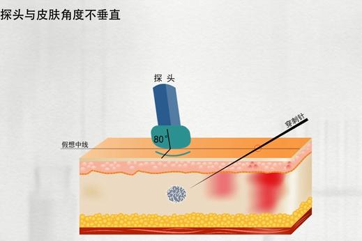 乳腺活检穿刺术操作方法,乳腺活检是怎么弄的