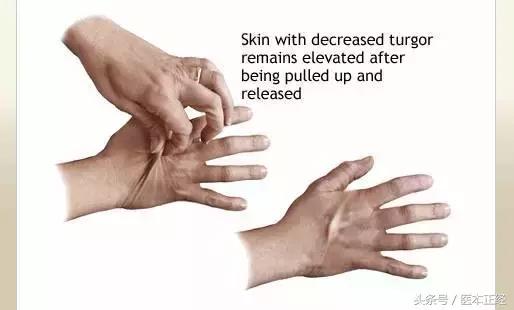 严重腹泻怎么自救缓解,腹泻严重程度