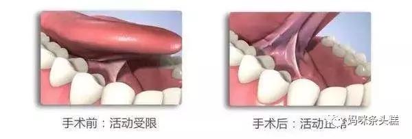 宝宝吐字不清训练方法,怎么样判断宝宝说话不清舌系带短