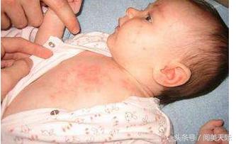 宝妈去痱子的方法,宝妈去痱子的秘方