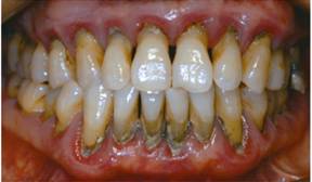 从来都没洗过牙的视频,有多少人从来没有洗过牙