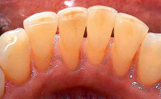 从来都没洗过牙的视频,有多少人从来没有洗过牙