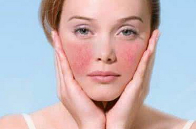 脸上一直好不了的*血丝红**需看完,你真的相信洋甘菊能彻底除掉它?