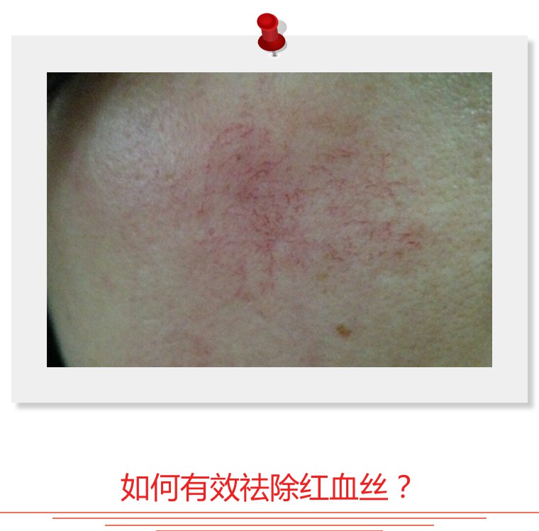 大腿上有血丝怎么祛除,血丝色斑