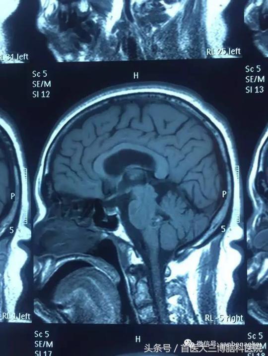 半年内多次脑出血心生绝望，学病友“跟风求医”