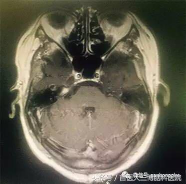 半年内多次脑出血心生绝望，学病友“跟风求医”