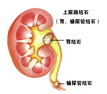 祖传秘方治结石,祖传秘方治疗结石抖音