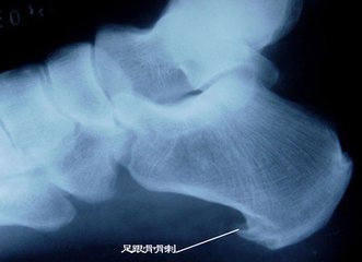 脚后跟长骨刺怎么办,膝盖长骨刺怎么办