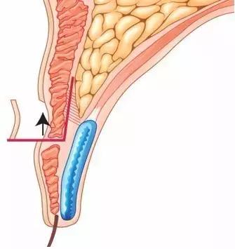 拿什么拯救术后三眼皮
