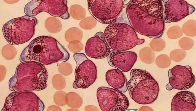 急性髓系白血病治疗费用要多少,m3型白血病治疗费用大概是多少