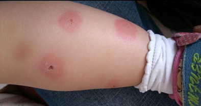 婴儿被蚊子叮咬起水泡需要处理吗,婴儿被蚊子叮咬后红肿硬起小水泡