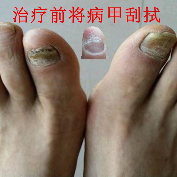 15天治愈灰指甲，一定要坚持喔！