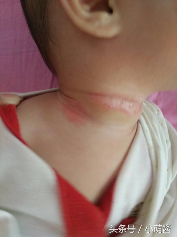 宝宝容易淹脖子怎么办,宝宝已经淹脖子怎么办