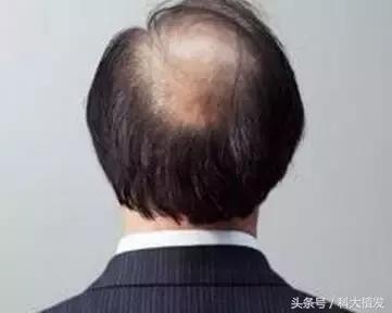 移植后的头发和正常头发有多大区别?