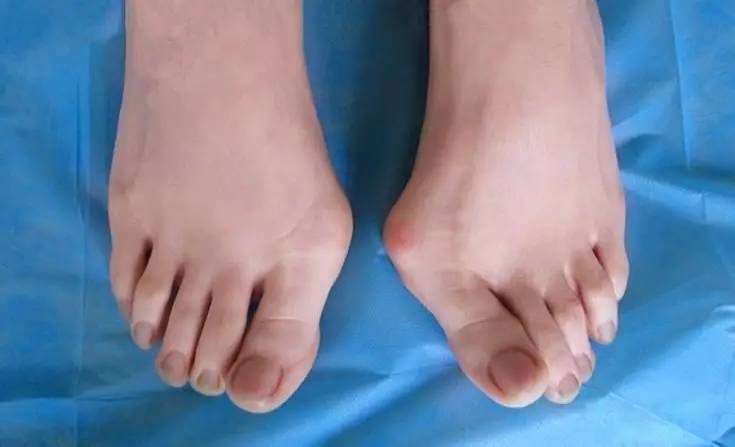 拇外翻和小脚趾内翻严重,拇外翻大脚骨弯曲