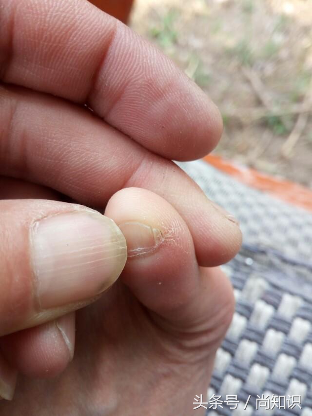 小脚趾甲为什么有两瓣的传说,为什么我们有两个小脚趾甲
