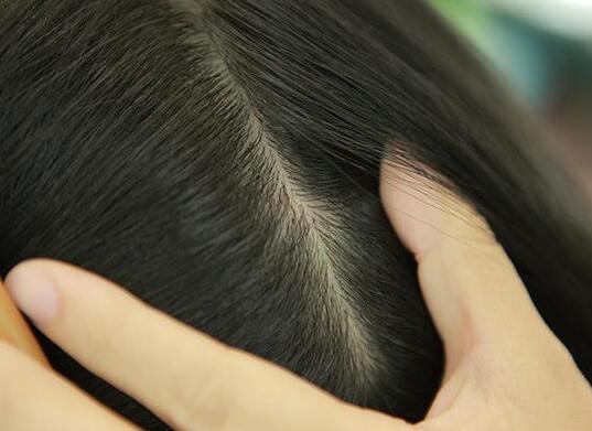 头皮屑有黄色痂块头皮发红,头皮上有一层白色的头皮屑还脱发