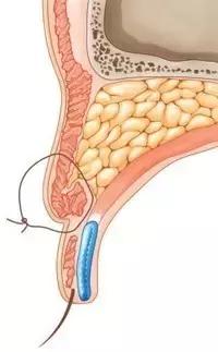 拿什么拯救术后三眼皮
