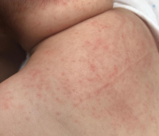 治疗婴儿痱子最快速有效的方法,宝宝头上的痱子治疗小妙招