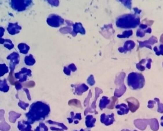 头皮屑有黄色痂块头皮发红,头皮上有一层白色的头皮屑还脱发