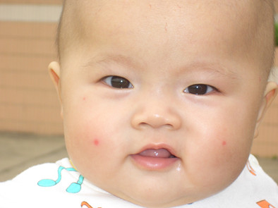 婴儿被蚊子叮咬起水泡需要处理吗,婴儿被蚊子叮咬后红肿硬起小水泡