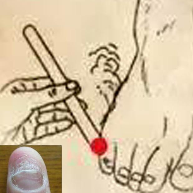 15天治愈灰指甲，一定要坚持喔！