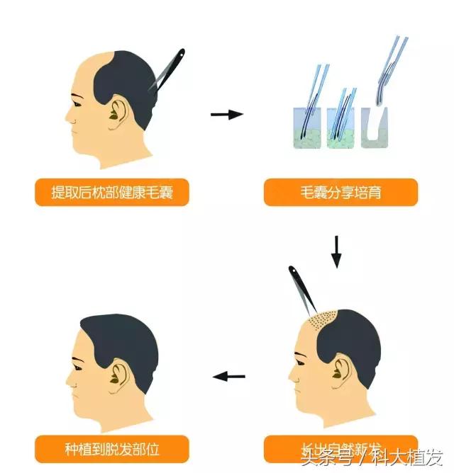 移植后的头发和正常头发有多大区别?