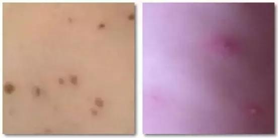 痱子不小心当湿疹治疗会怎么样,痱子小红点