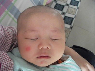 婴儿被蚊子叮咬起水泡需要处理吗,婴儿被蚊子叮咬后红肿硬起小水泡